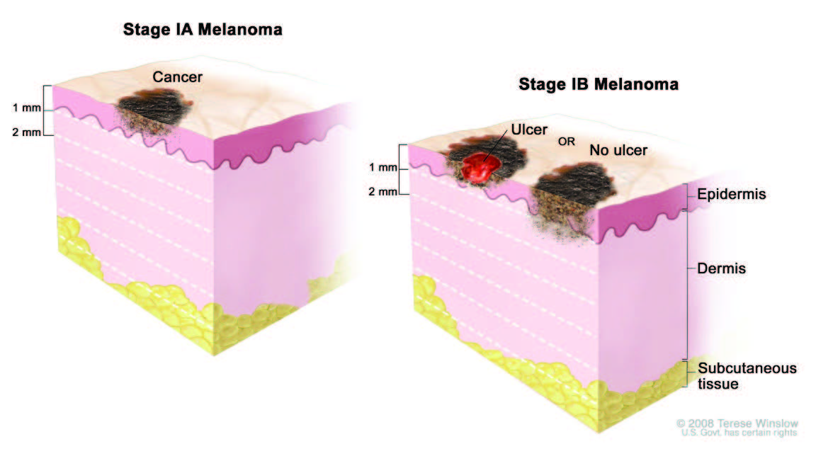 Melanoma Stage 0 PDF Linear Malignant Melanoma In Situ Reports And