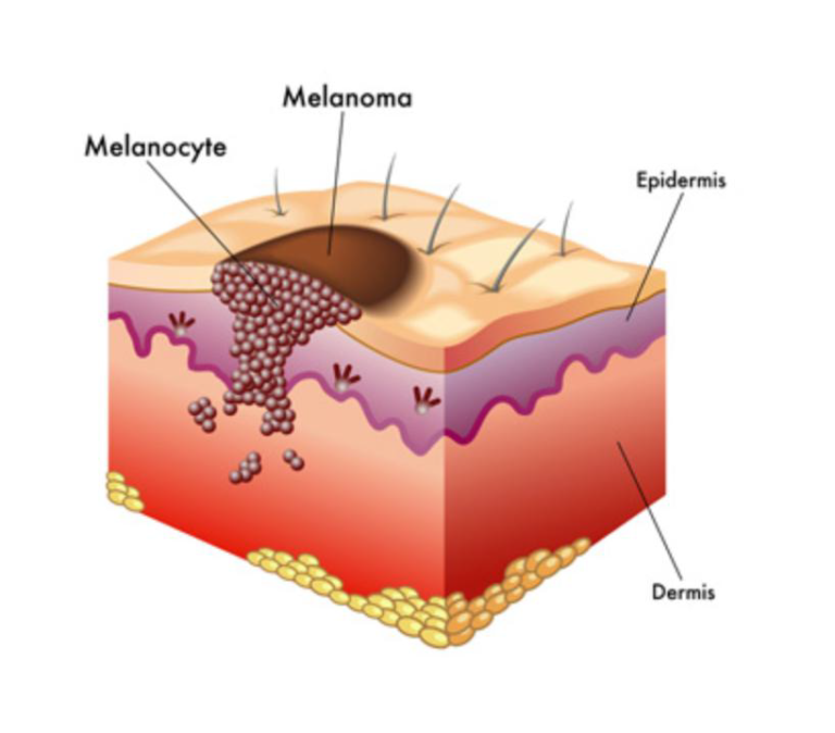 image of melanoma on skin
